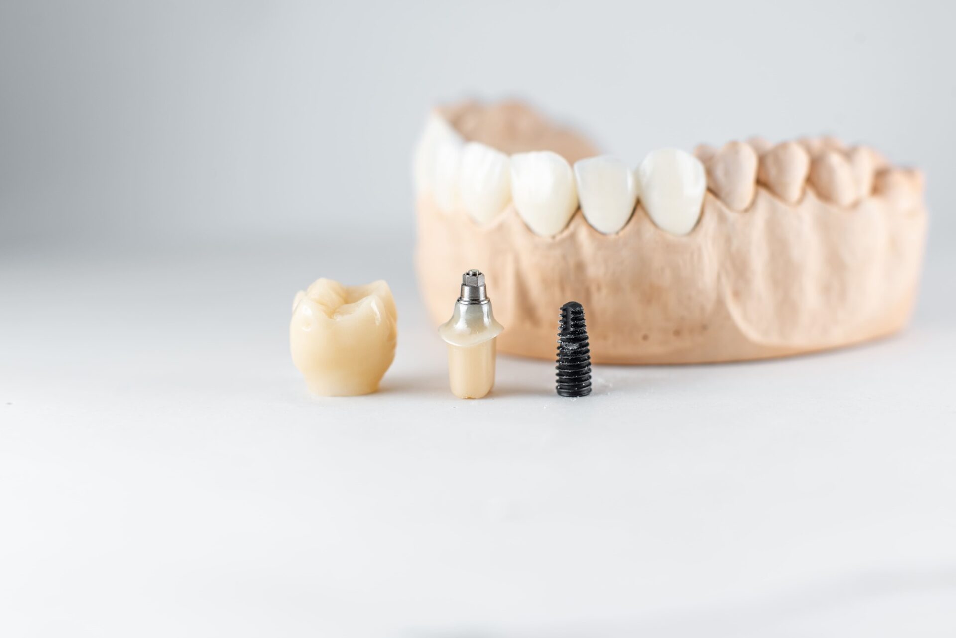 model of artificial jaw and dental implant 2023 11 27 05 19 37 utc 1