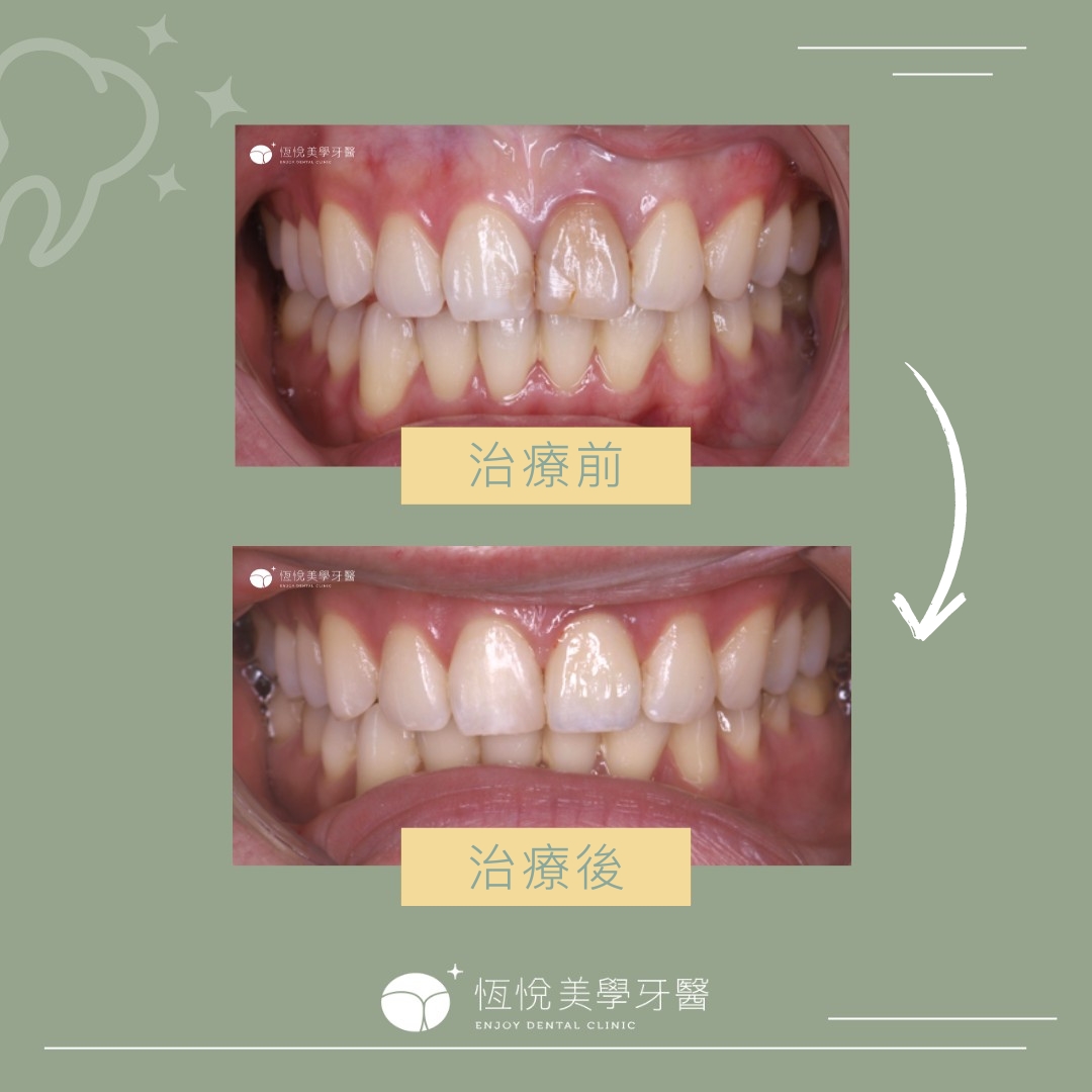 Read more about the article 根管治療後牙齒變色案例-李小姐