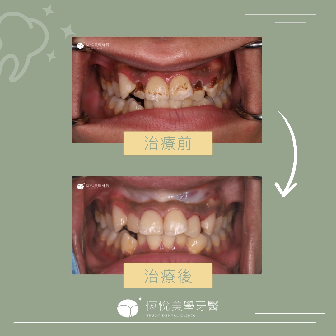 Read more about the article 嚴重蛀牙案例 – 林先生