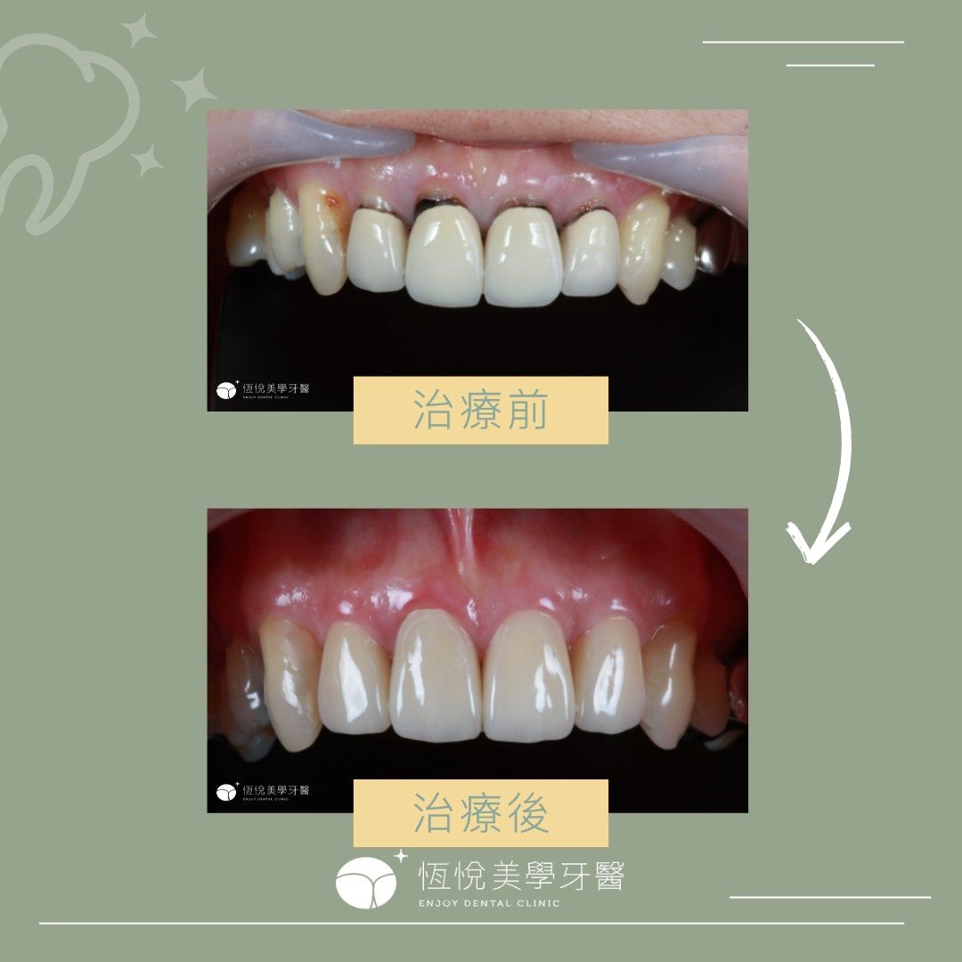 Read more about the article 全瓷冠假牙換新案例 – 莫先生