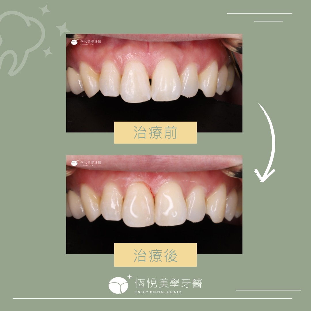 Read more about the article 牙齦萎縮案例-游小姐