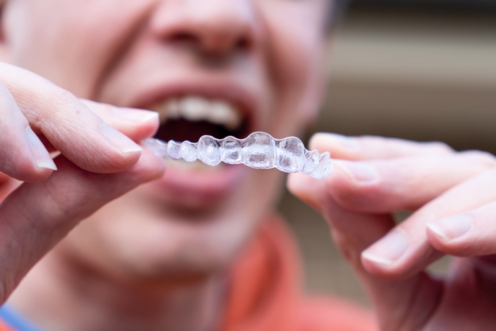 man-holds-put-on-invisible-braces-invisalign-plas-2022-11-15-14-04-40-utc (1)