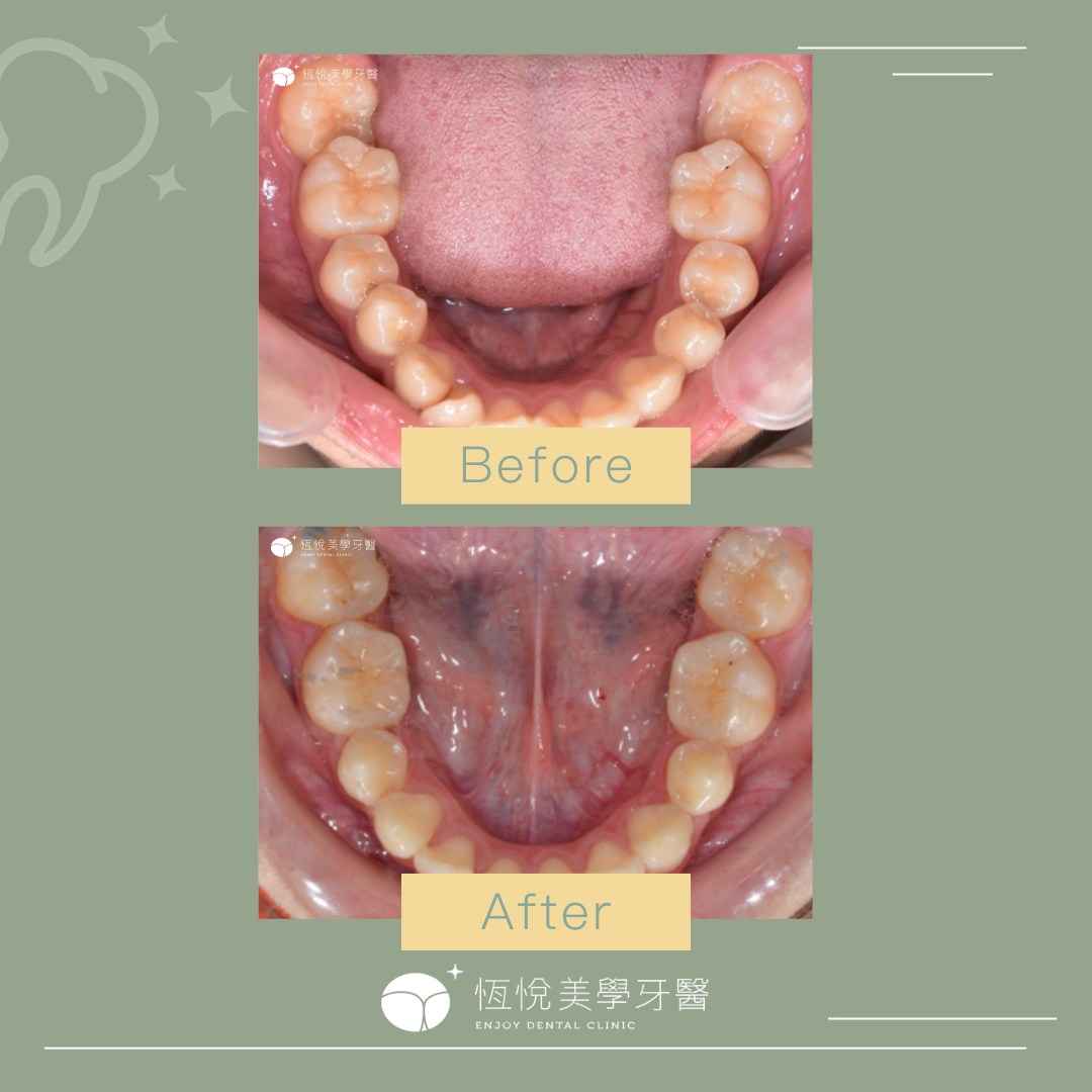暴牙24w隱適美分享 - 牙齒矯正板 | Dcard