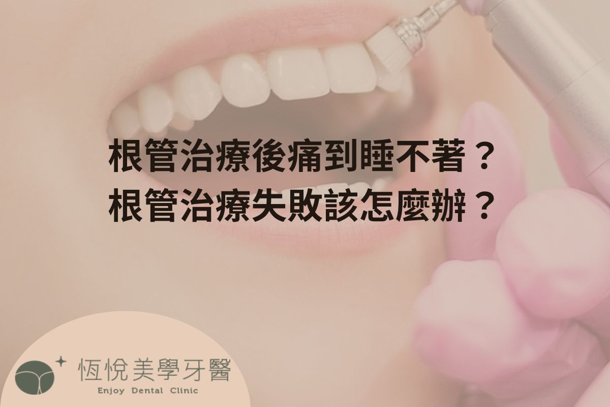Read more about the article 根管治療後痛到睡不著？根管治療失敗該怎麼辦？
