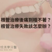 根管治療後痛到睡不著？根管治療失敗該怎麼辦？