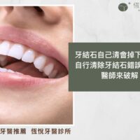 牙結石自己清會掉下來嗎？自行清除牙結石錯誤迷思多，醫師來破解
