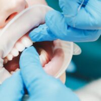 close-up-of-female-mouth-with-retractor-doctor-fl-2022-12-16-21-40-55-utc (1)