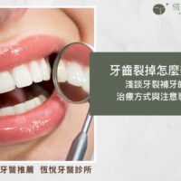 牙齒裂掉怎麼辦？ 淺談牙裂補牙的治療方式與注意事項