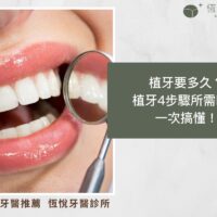 植牙要多久？植牙4步驟所需時間一次搞懂！