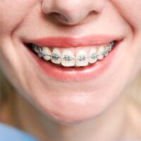 smiling-young-woman-with-braces-on-teeth-2022-05-30-22-50-19-utc (2)
