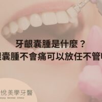 what-is-a-gingival-cyst