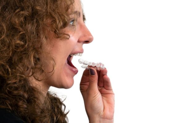 woman-put-transparent-braces-dental-correction-in-2022-09-29-17-30-37-utc (1)