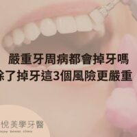 補骨粉不能省，醫：忽略補骨恐釀植牙失敗 (2)