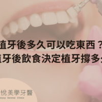 植牙後多久可以吃東西？植牙後飲食決定植牙撐多久