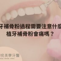 補骨粉不能省，醫：忽略補骨恐釀植牙失敗 (9)